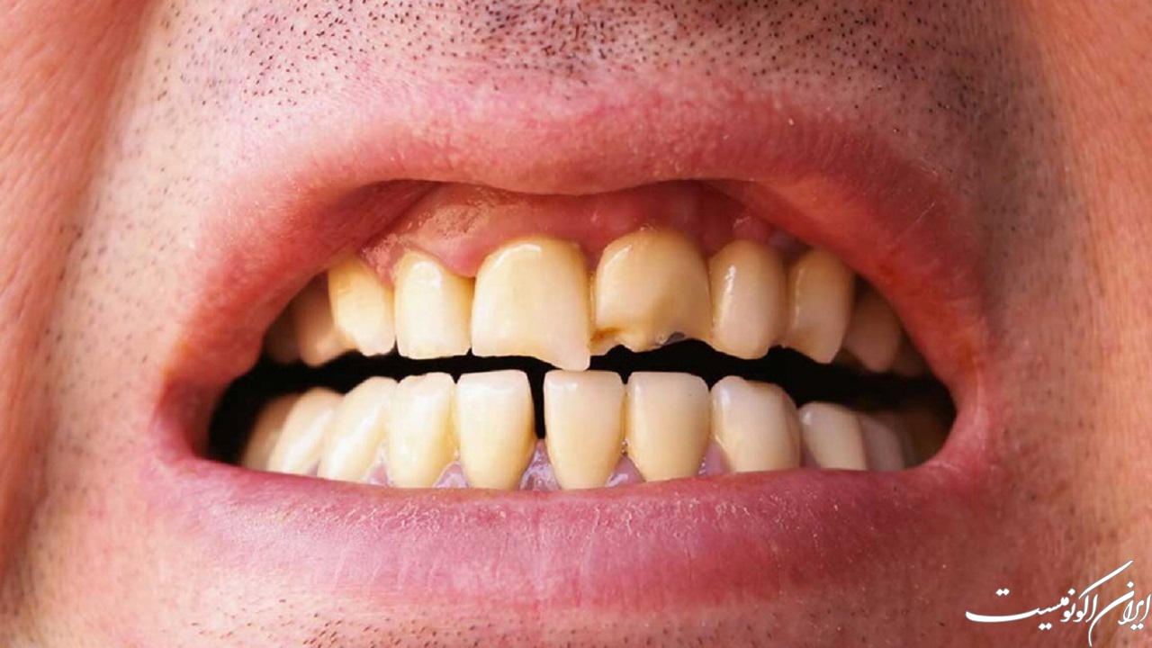 7 عادت بد که به شدت برای دندان‌ها مضرند