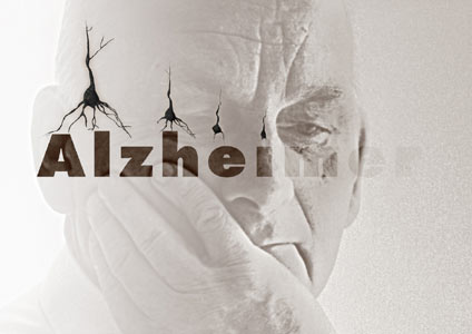  بیماری آلزایمر