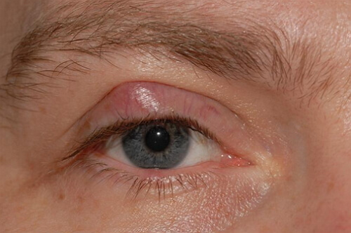 علائم کیست پلک چشم چیست+ اینفوگرافی