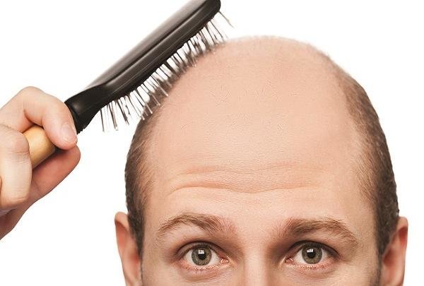 کنترل ریزش ارثی مو باید از نوجوانی آغاز شود