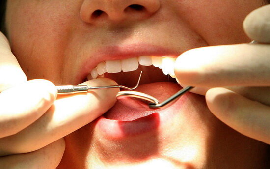 هر ۳ سال یک دندان پوسیده به دهان ایرانیان اضافه می‌شود