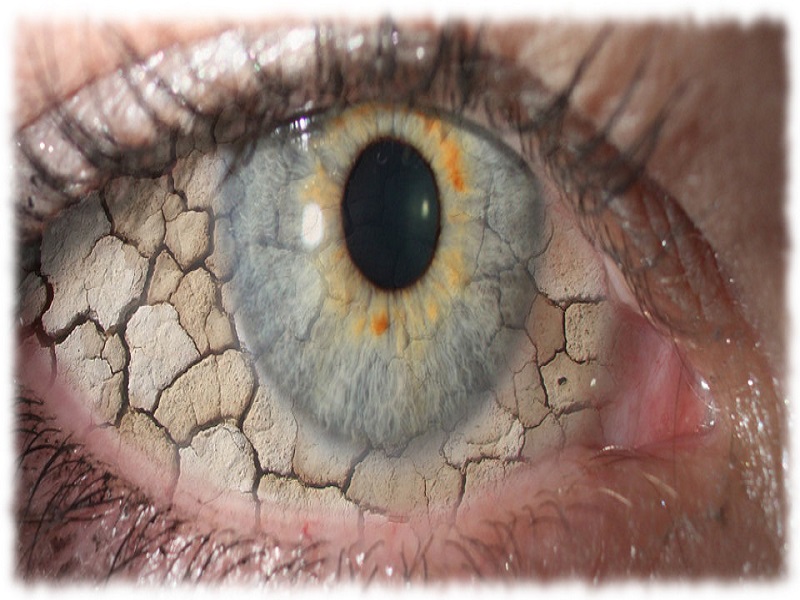 دلایل ایجاد و درمان خشکی چشم را بشناسید/ آیا مشکلات چشمی باعث ایجاد میگرن می‌شوند؟