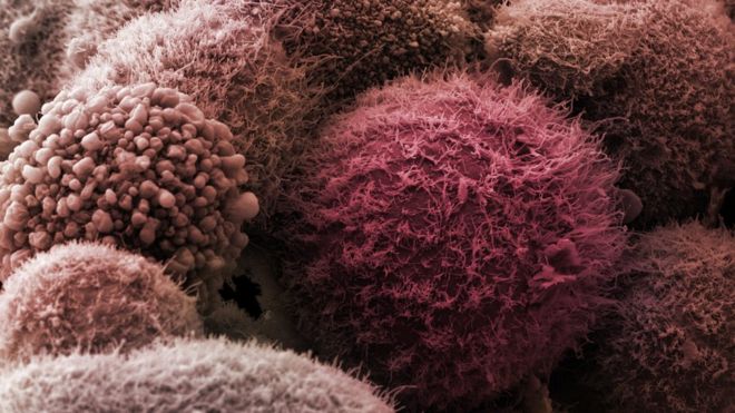 سرطان پانکراس در کمین چه کسانی است؟ +اقدامات درمانی اولیه