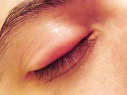 تومورهایی که در کمین چشمانتان نشسته‌اند +روش درمانی تومورهای چشم و حدقه