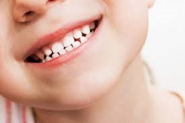 کشیدن دندان‌های شیری کودکان بدون توجیه مشکل ساز می‌شود