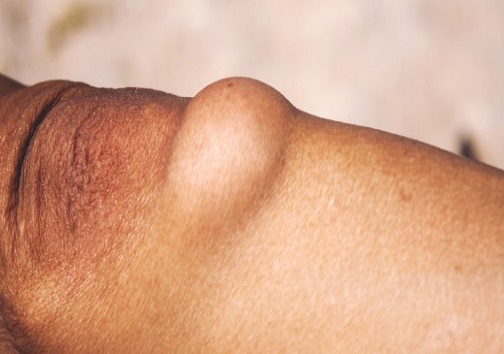 تومور‌های خوش خیم غیرسرطانی پوستی چیست؟ + راه شناخت و درمان