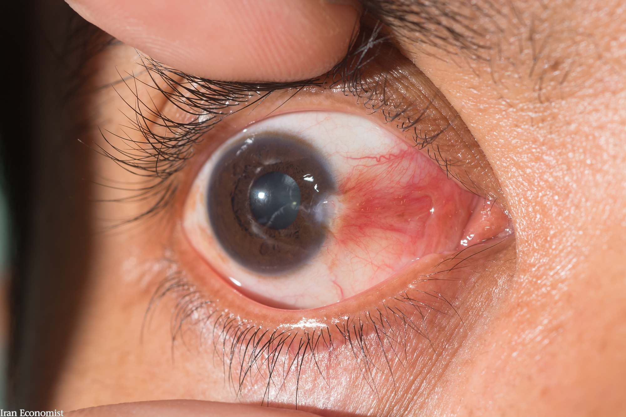 بیماری بد شکلی که چشم‌تان را زشت می‌کند +راه درمان و پیشگیری