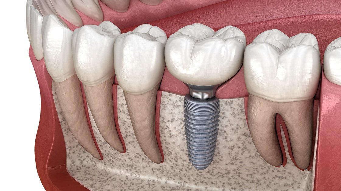 5 نکات مهم درباره ایمپلنت دندان