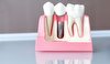 5 نکته مهم درباره ایمپلنت دندان