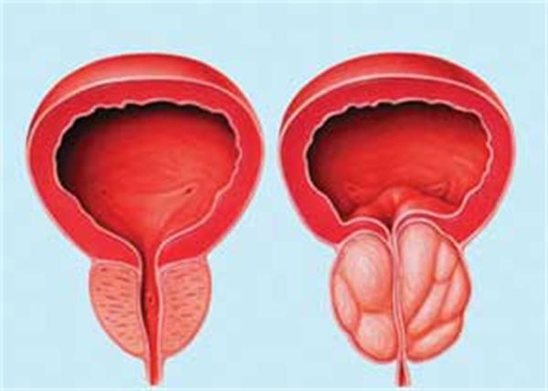 سرطان پروستات چیست + روش های درمان سرطان پروستات چیست + روش های درمان