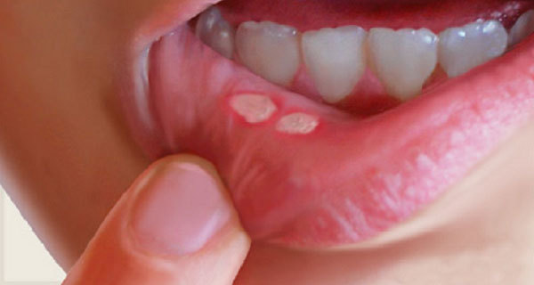 درمان آفت دهان با ۷ فرمول طبیعی/ مسکن‌هایی که زخم دهنتان را فوری تسکین می‌بخشند