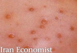 ویروس زونا از چه طریقی منتقل می‌شود؟