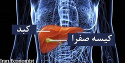 آنچه باید درباره سنگ «کیسه صفرا» بدانید