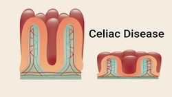 گلوتن بیماری سیلیاک را تشدید می‌کند