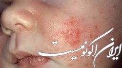 طغیان  سرخک  در افغانستان و ضرورت آمادگی دانشگاه‌های علوم پزشکی