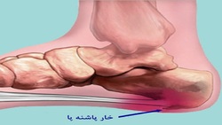 راه‌های درمان خارپاشنه بدون جراحی