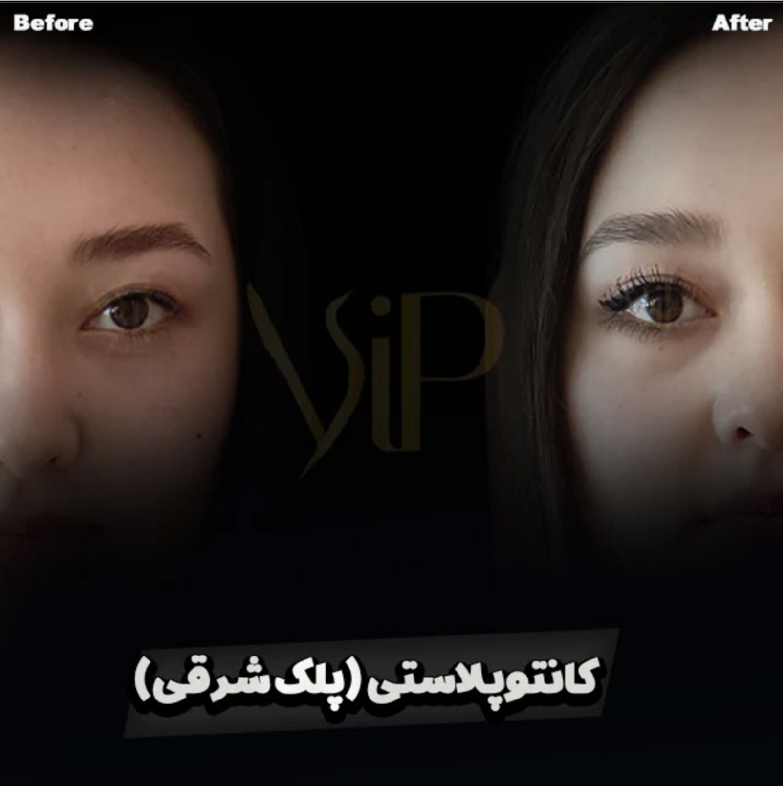 بهترین دکتر برای عمل چشم گربه ای 