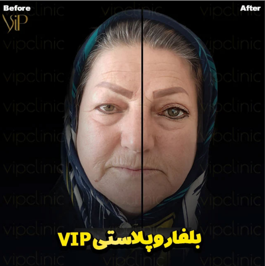 بهترین دکتر برای عمل چشم گربه ای 