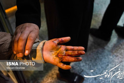 اقدامات اورژانسی در مواجهه با فردی که دچار سوختگی شده است