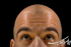 افراد طاس به نوع شدید کرونا مبتلا می‌شوند؟