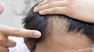 FDA اولین داروی ریزش مو را برای آلوپسی شدید تایید کرده است.