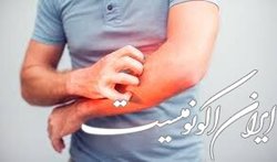 چند ماده غذایی موثر برای جلوگیری از آفتاب سوختگی