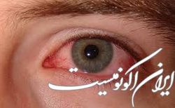 خشکی چشم با افزایش سن شیوع می‌یابد