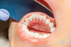 یادگیری ماشینی، ابتلا به سرطان دهان را پیش‌بینی می‌کند