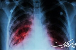 فرمول جدید دانشمندان آمریکایی برای مقابله موثر با سل