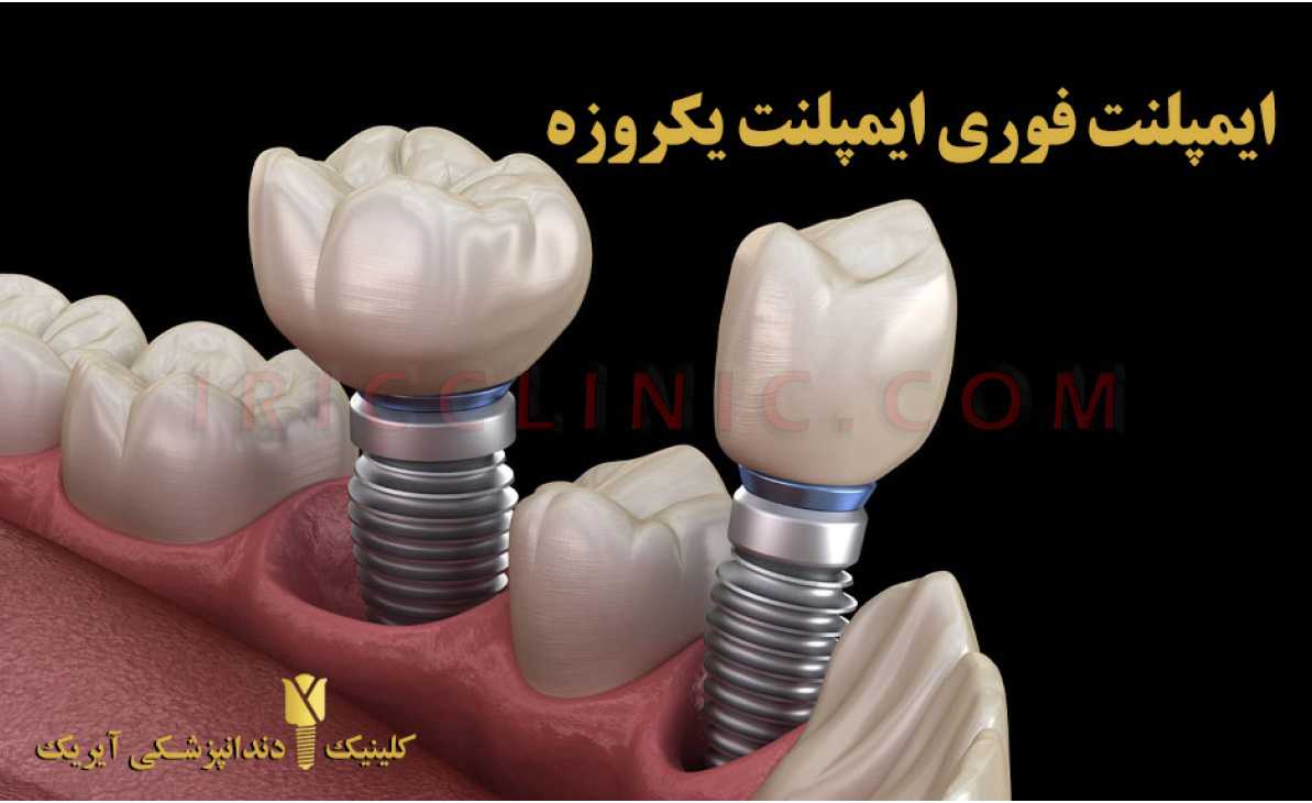 ایمپلنت دندان بهترین روش کاشت دندان