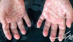 آمریکا رکورددار ابتلا به آبله میمونی در جهان