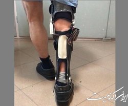 بهبود بازسازی مفصل عضلانی با آلیاژ تیتانیوم