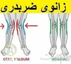 ۴ ورزش ویژه برای زانوی ضربدری کودکان