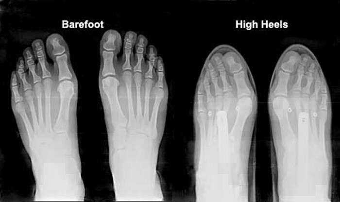 پوشیدن کفش زنانه نامناسب چه عوارضی برای بدن دارد؟