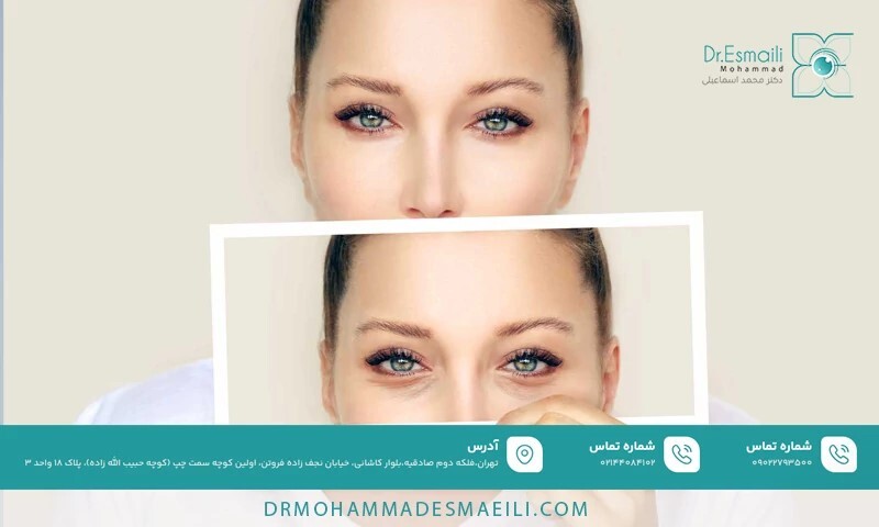 هنگام انتخاب دکتر برای بلفاروپلاستی به چه مواردی توجه کنیم؟