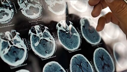 کلید مولکولی آلزایمر پیدا شد / راهی جدید برای نجات حافظه