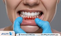 7 نشانه خطرناک بیماری لثه که نباید نادیده بگیرید!