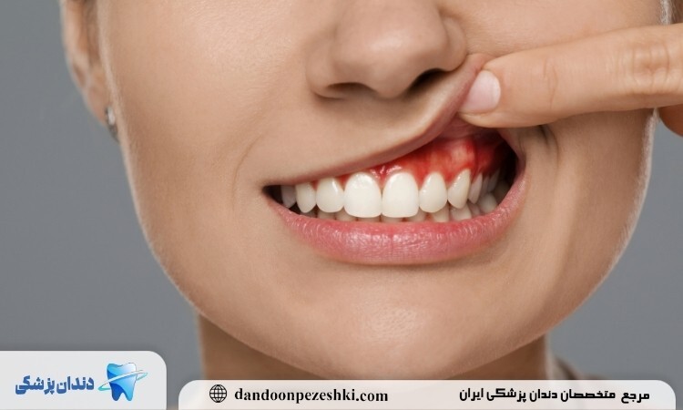 7 نشانه خطرناک بیماری لثه که نباید نادیده بگیرید!