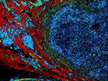 پالس‌های الکتریکی کم‌توان به جنگ سرطان می روند