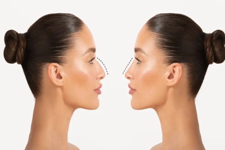 بهترین جراحی بینی در ایلام کجاست ؟ بهترین جراحی بینی در ایلام کجاست ؟