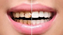 لمینت دندان چیست؟