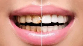 لمینت دندان چیست؟