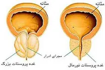 چگونه از سرطان پروستات مطلع شویم
